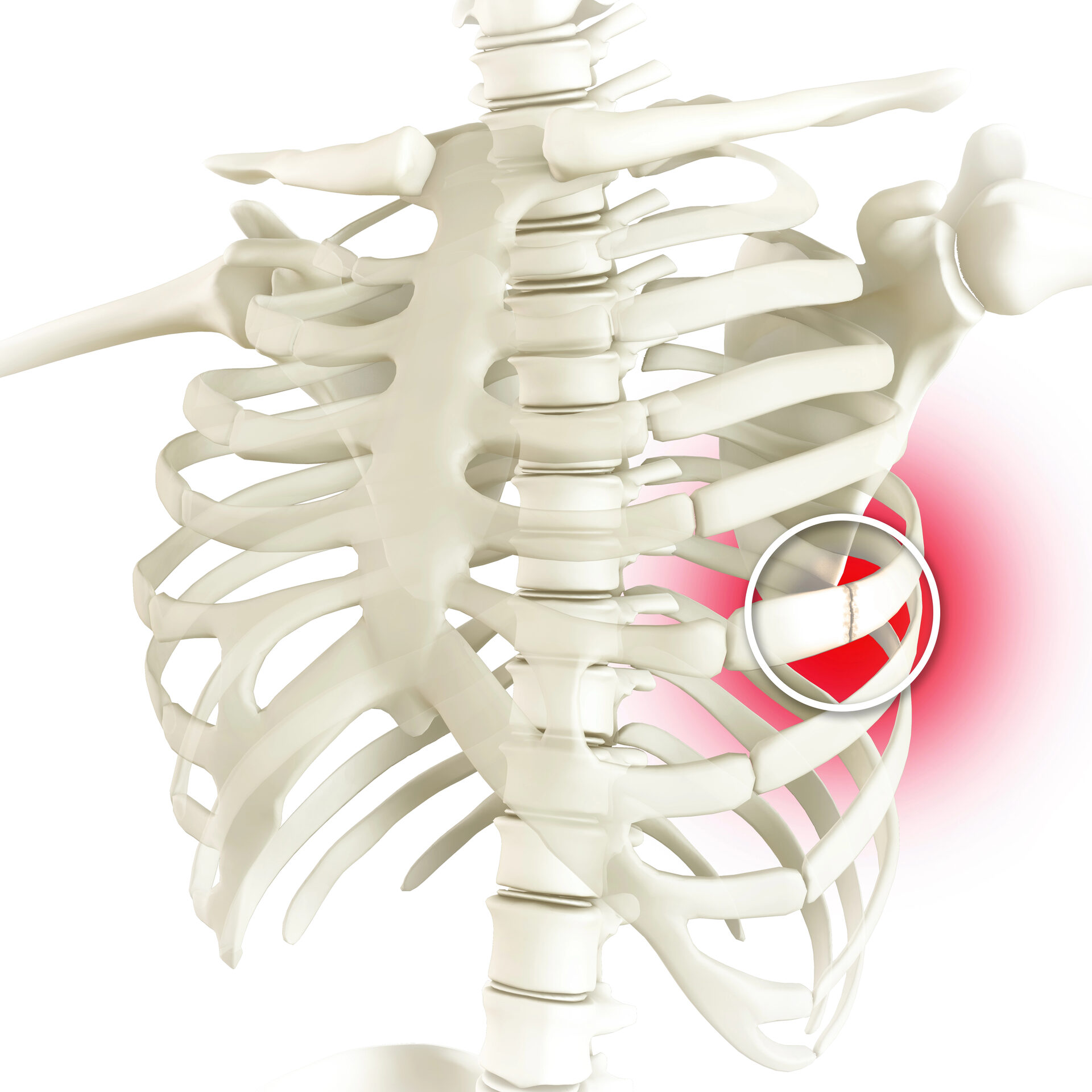 Costochondritis & Chest Wall Pain illustration