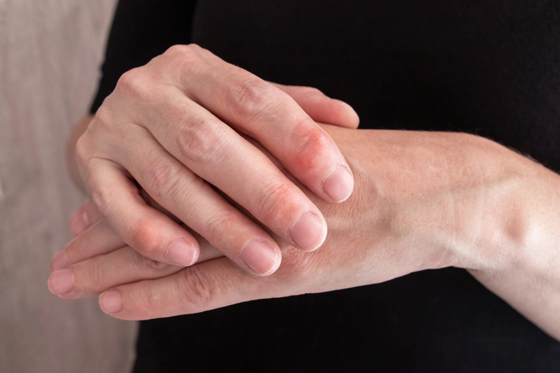 Complex Regional Pain Syndrome (CRPS) illustration