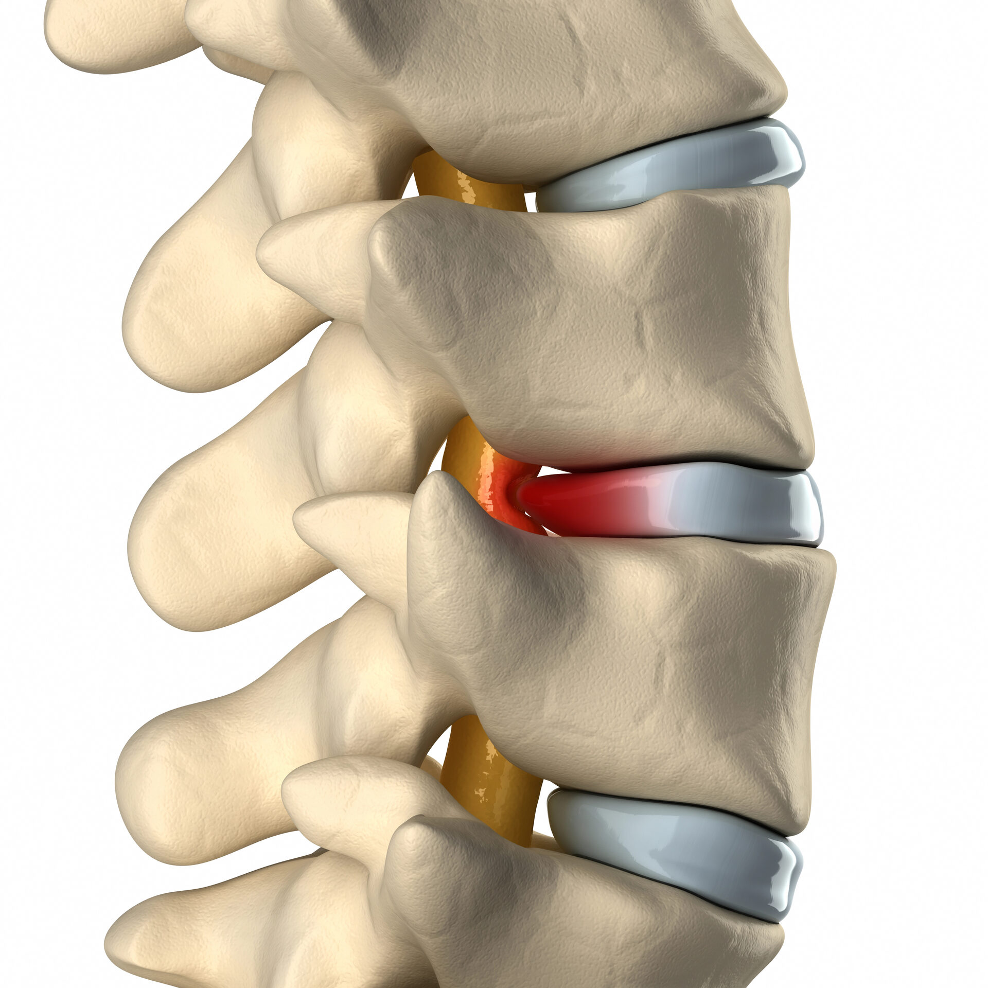 Herniated Disc illustration