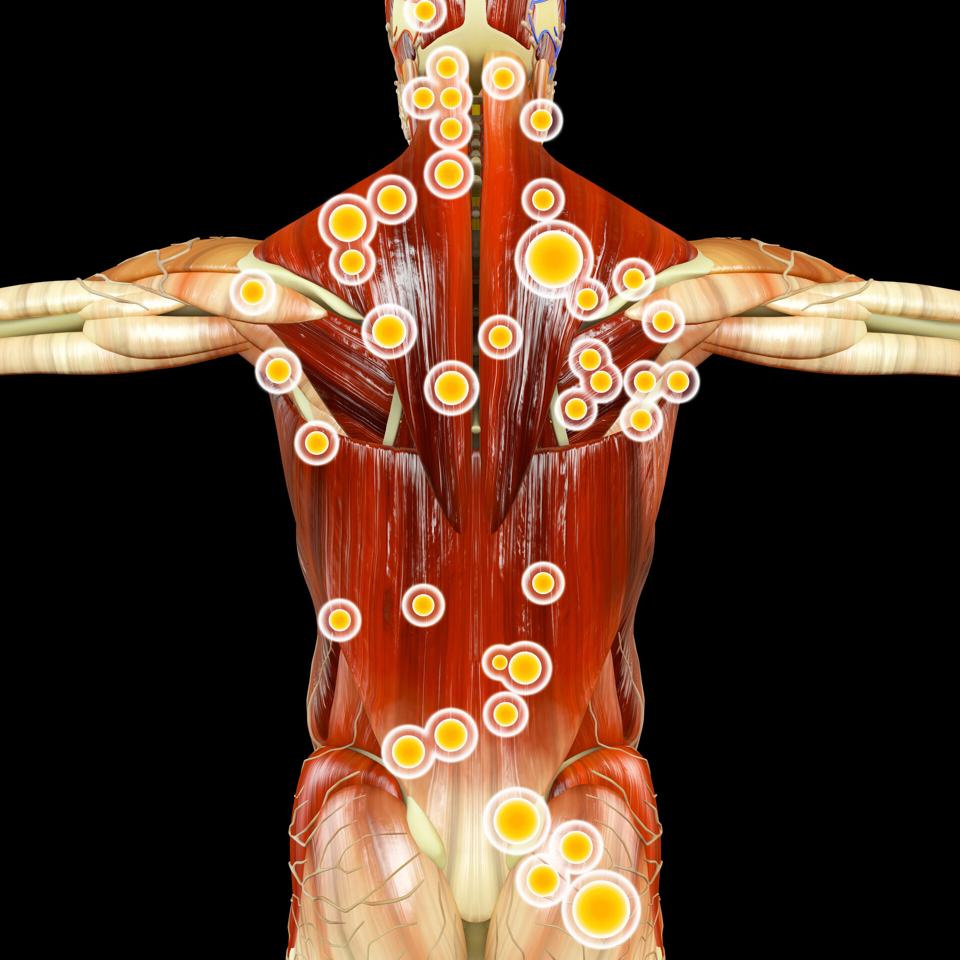 Myofascial Pain Syndrome illustration